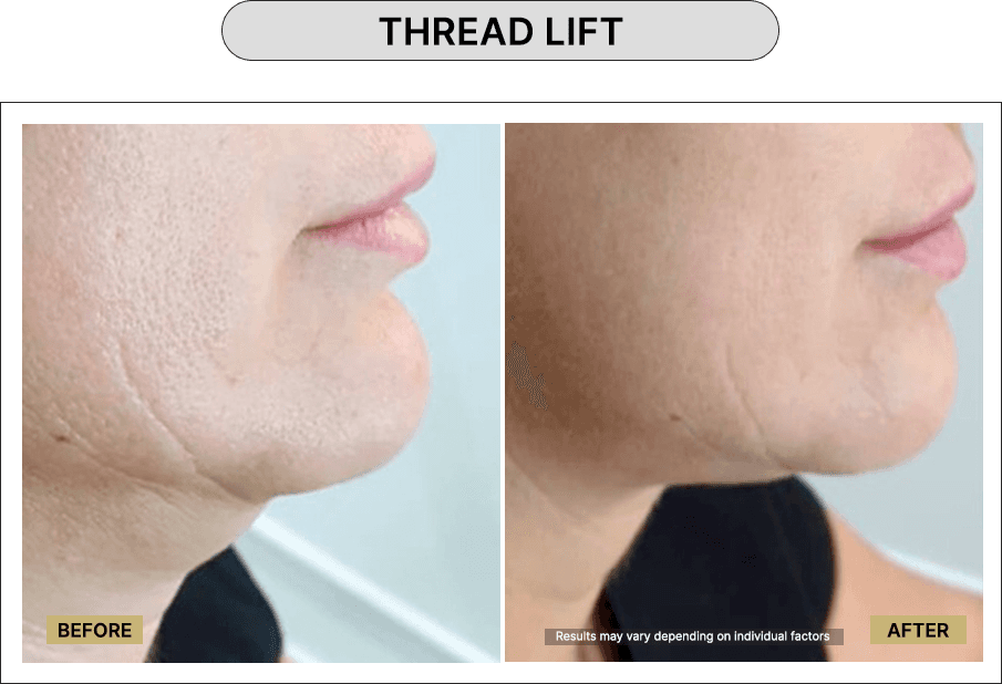Thread Lift