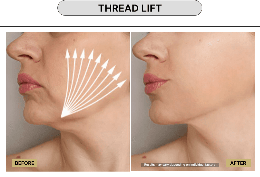 Thread Lift