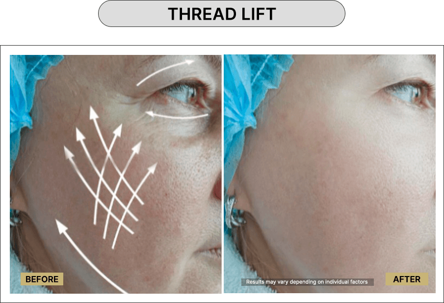 Thread Lift