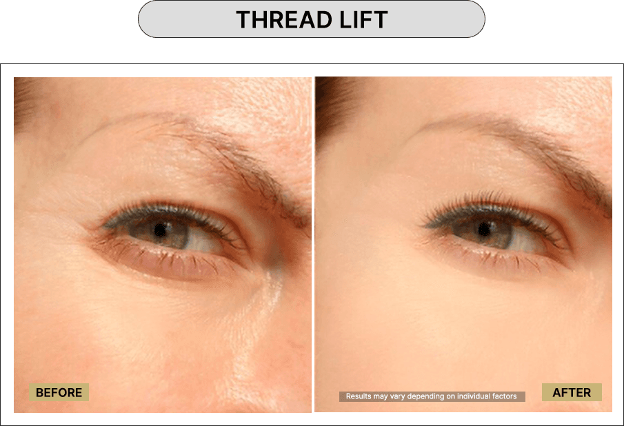 Thread Lift