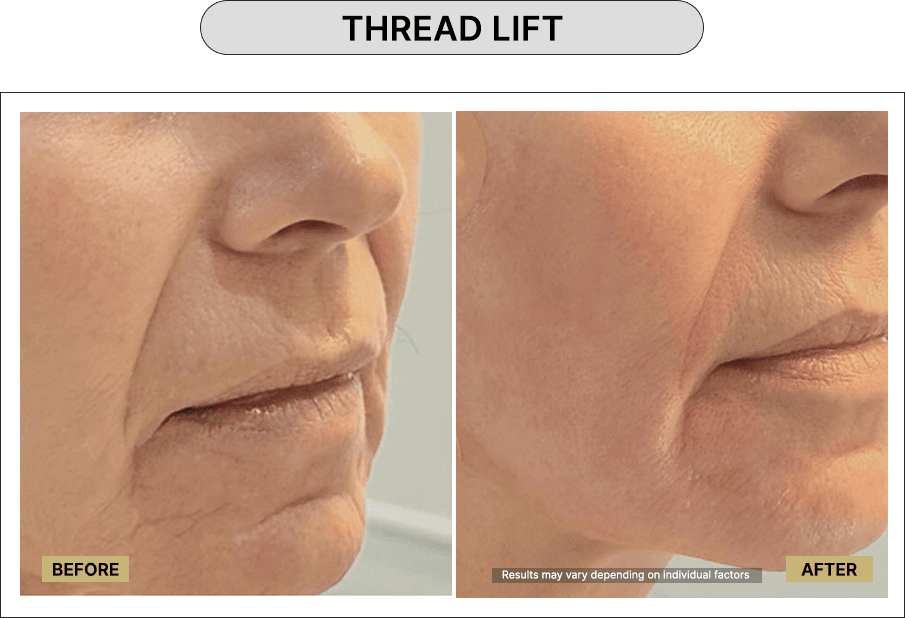 Thread Lift