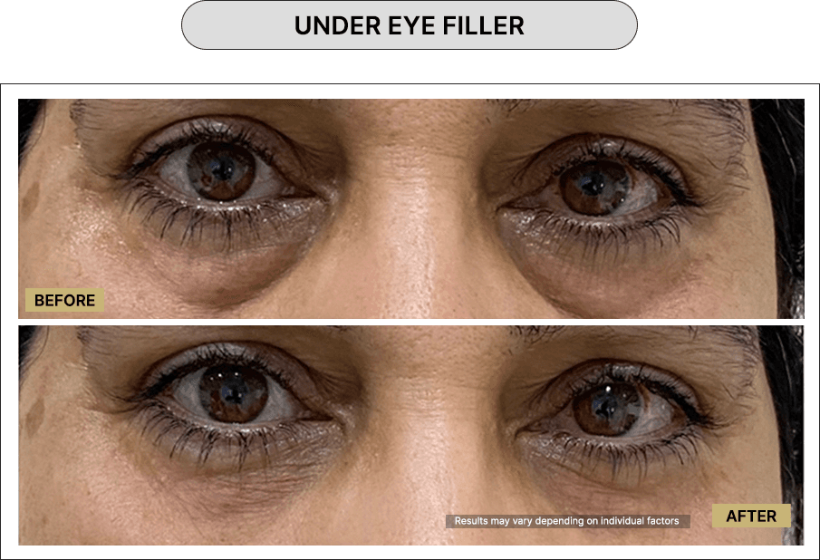 Under Eye Filler