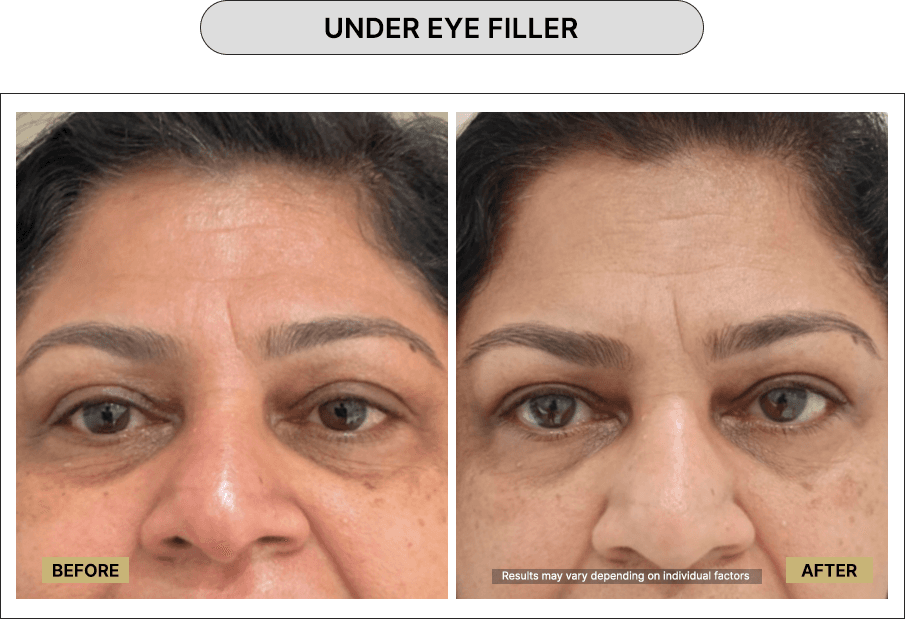 Under Eye Filler