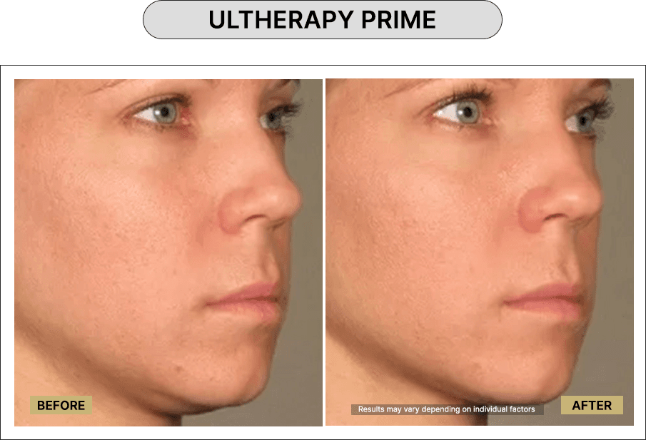 Ultherapy Prime