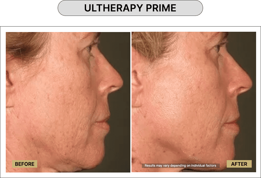 Ultherapy Prime