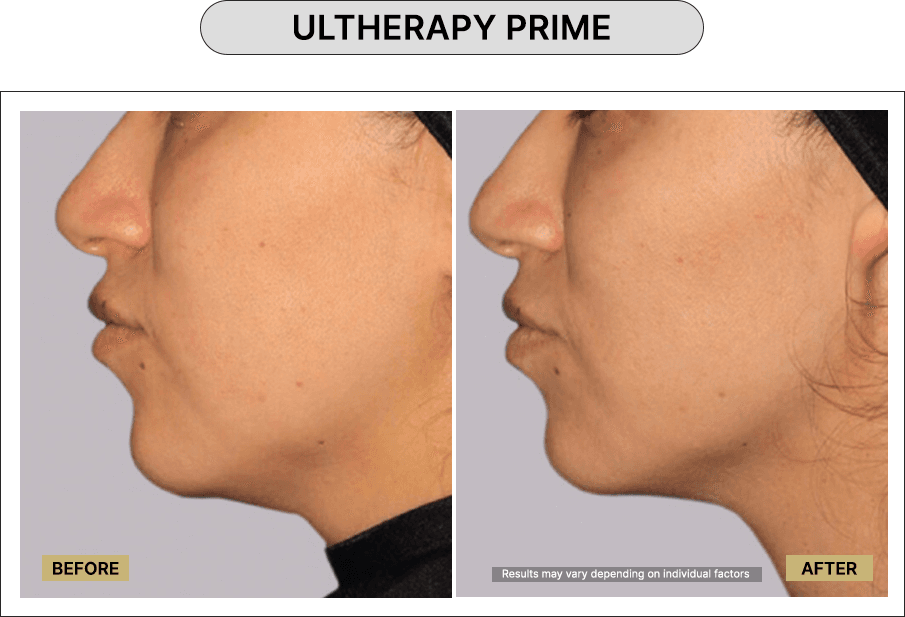 Ultherapy Prime
