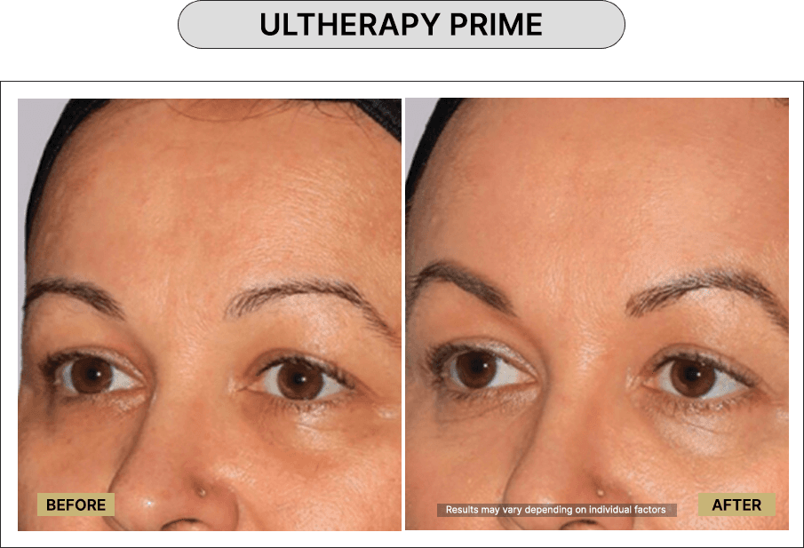 Ultherapy Prime