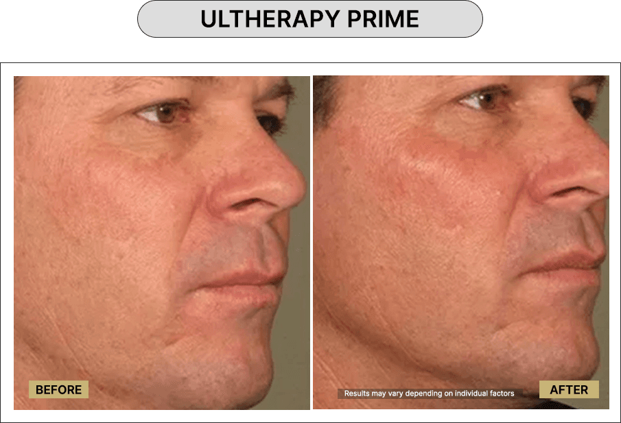 Ultherapy Prime